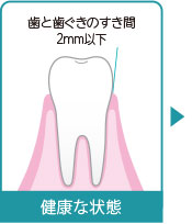 歯と歯ぐきのすき間2mm以下　健康な状態