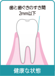 歯と歯ぐきのすき間2mm以下　健康な状態