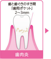 歯と歯ぐきのすき間「歯周ポケット」2～3mm　歯肉炎
