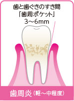 歯と歯ぐきのすき間「歯周ポケット」3～6mm　歯周炎(軽～中程度)