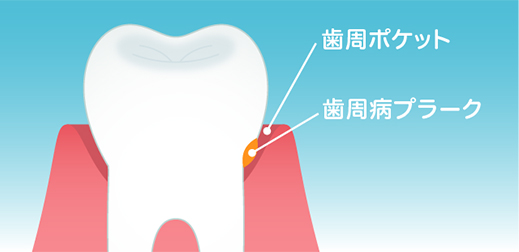 さまざまなお口トラブルを引き起こす『歯周病』その原因は、歯周病プラーク*