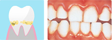 歯肉炎の状態の歯周組織