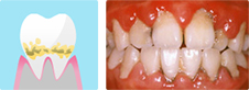 歯周炎の状態の歯周組織