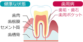 歯周病は歯ぐきの病気