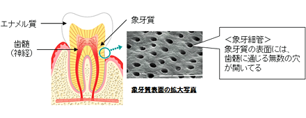 象牙質表面の拡大写真 <象牙細管> 象牙質の表面には、歯髄に通じる無数の穴が開いてる
