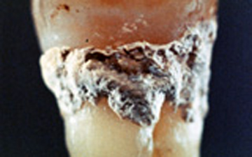 歯の表面に付着した歯石