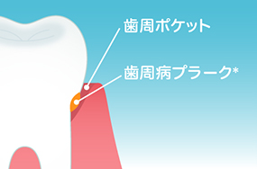 歯周病の解説