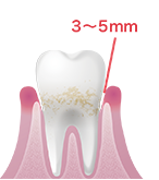 歯周炎(軽度)